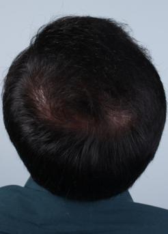 After Hair Transplant&nbsp;Midscalp